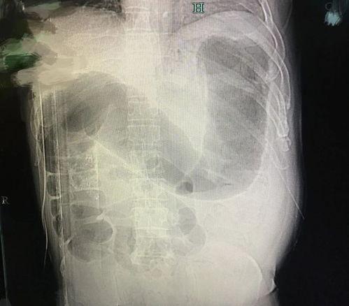 男子吃瓜肠梗阻视频,紧急救治过程曝光